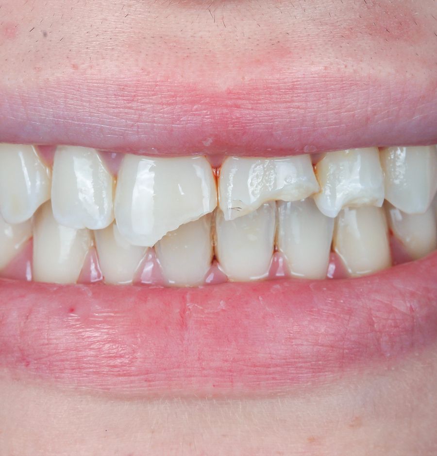 Chipped tooth before